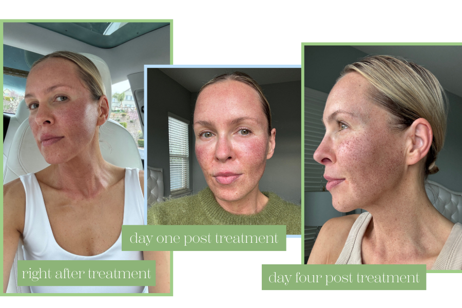 HALO TRIBRID laser healing timeline day 3 swelling