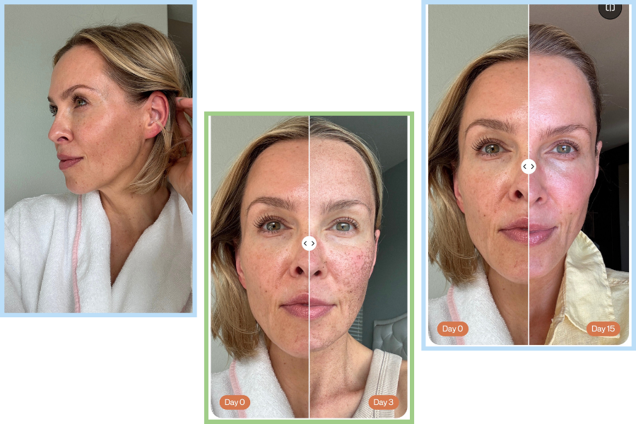HALO TRIBRID before and after skin results