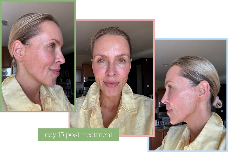 HALO TRIBRID laser treatment results after healing