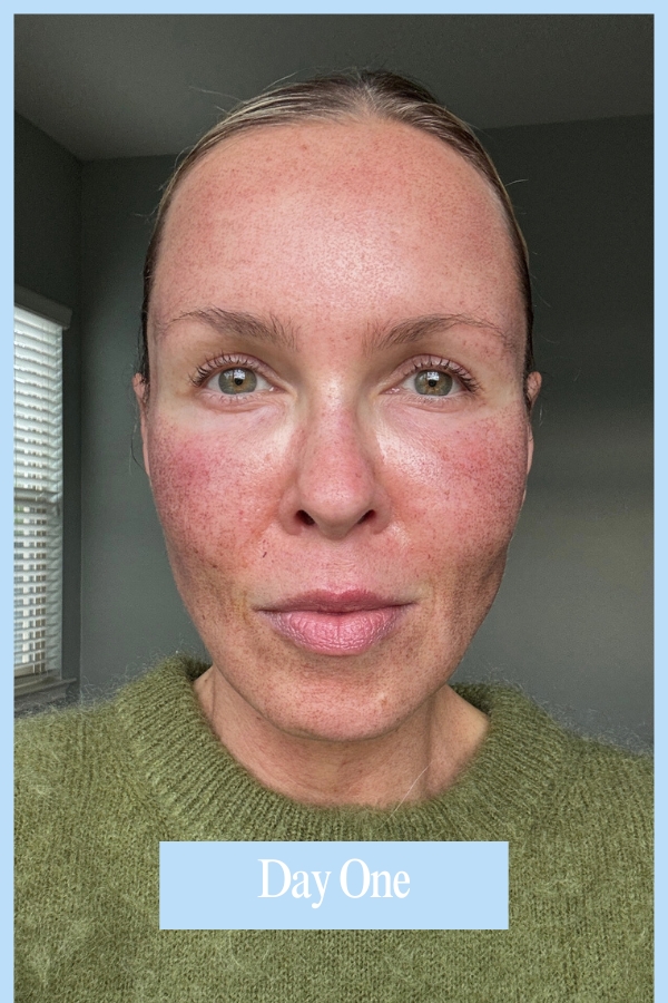 HALO TRIBRID before and after skin results